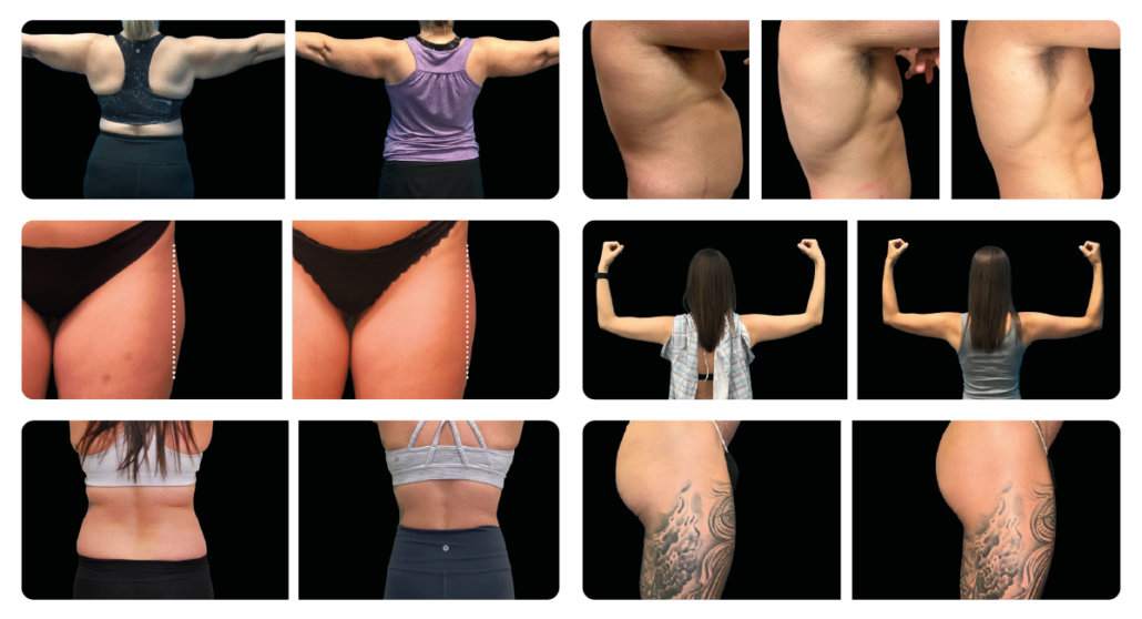 emsculpt neo before and after