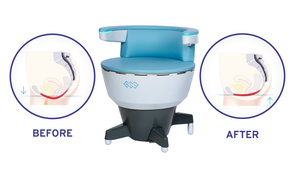 emsella pelvic floor treatment before and after